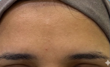 بعد علاج التجاعيد